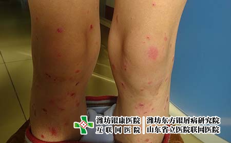 吃蝌蚪能不能治疗牛皮癣