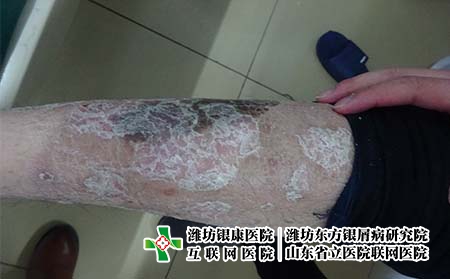 面部出现银屑病后如何治疗