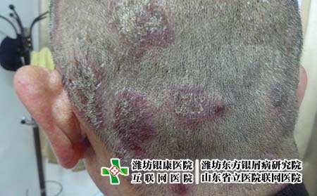 牛皮癣是怎样产生的