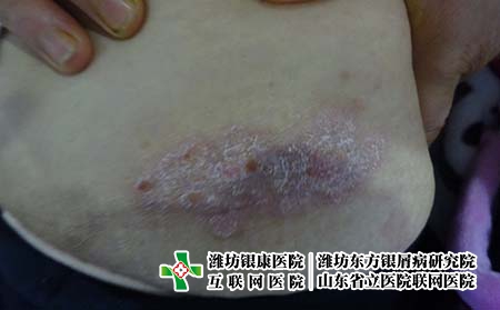 潍坊哪个牛皮癣医院比较正规?