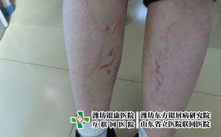 治疗牛皮癣时应该注意什么呢