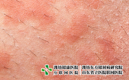 摄图网_303285488_Eczemaoti皮肤炎症状纹理（企业商用）