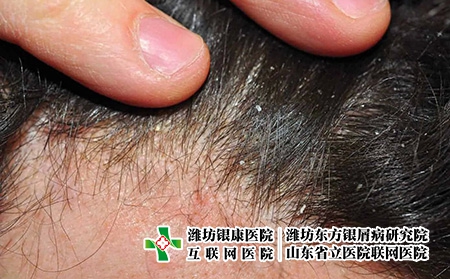 头皮牛皮癣4