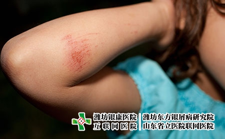 摄图网_501485759_手臂擦伤的年轻女孩（企业商用）