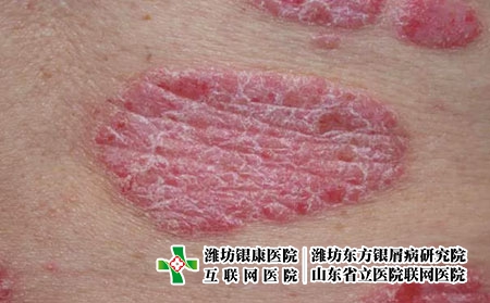 斑块状银屑病2