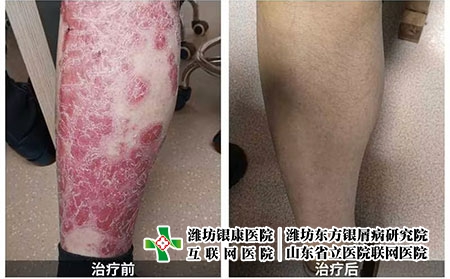 寻常性型银屑病-男性-50岁-真人患者案例对比