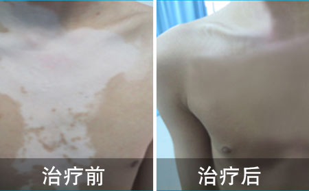 白癜风恢复案例
