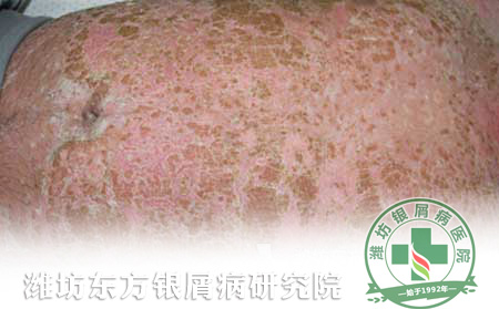 关于银屑病身心疾病属性的临床研究