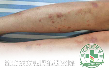 医生浅谈秋季银屑病护理方法
