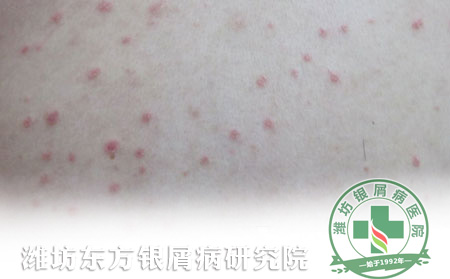 夏季银屑病患者如何饮食保健