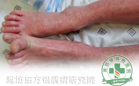 牛皮癣不传染 治疗重在排脏毒