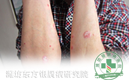 银屑病医疗方面的护理应该怎样进行