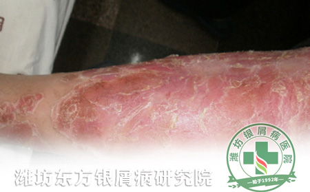 银屑病患者怎么改善局部皮损