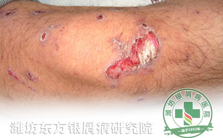 银屑病的护理要从哪些方面入手