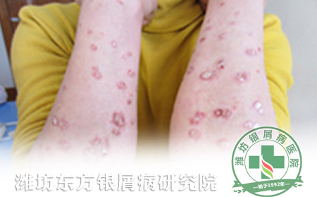 光敏性银屑病发病因素介绍