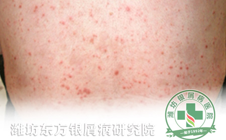 银屑病患者如何进行家庭护理