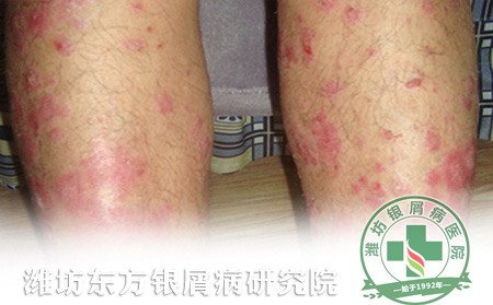 腿上长了牛皮癣怎么护理可以