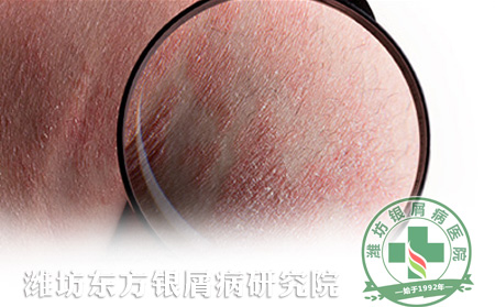 潍坊东方银屑病研究院提示您银屑病导致的皮肤变色原因