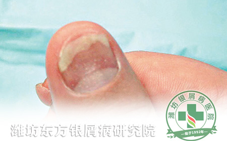 潍坊东方银屑病研究院春季牛皮癣复发征兆