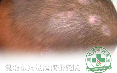 头部银屑病怎样止痒