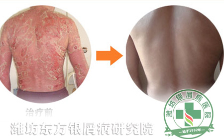 临床治疗银屑病才是王道