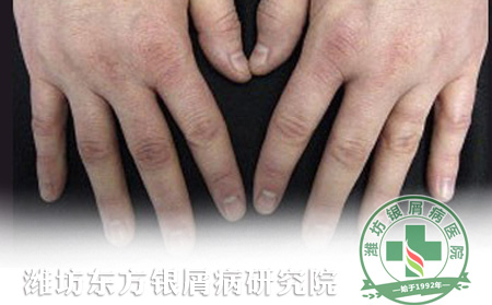 美国皮肤医学会提供的银屑病护理建议