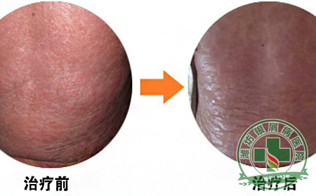 银屑病不是婚姻的阻碍