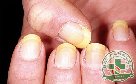 指甲病变代表银屑病患者身体出问题了 