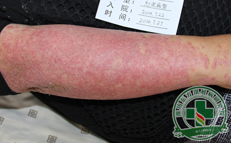 季节养生：银屑病患者切忌过早过夏天