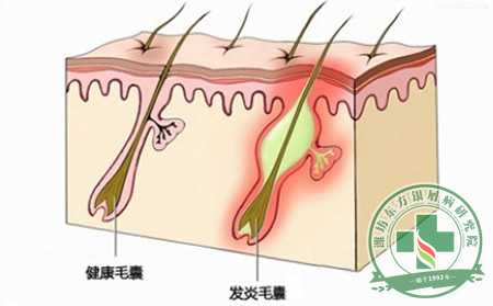 敏感性皮肤的银屑病患者生活中要如何保养