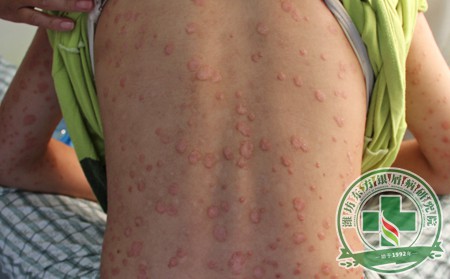 不治疗寻常型银屑病能怎么着？会有严重后果吗？