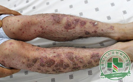 如何护理 银屑病患者降低得重症银屑病的可能