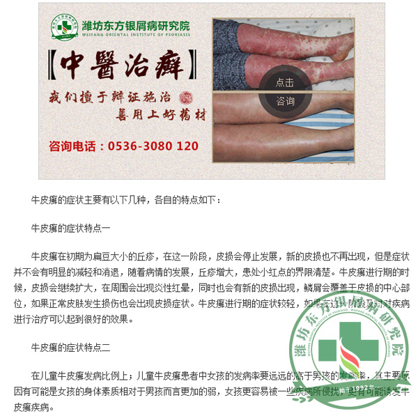东方多角度详解牛皮癣症状表现
