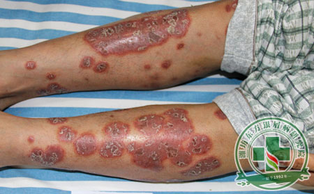 皮疹上面流脓液 是脓疱型银屑病的症状所带来的吗