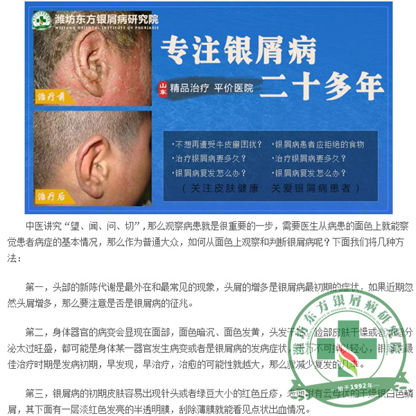 潍坊东方银屑病研究院：怎么看是不是头部银屑病？