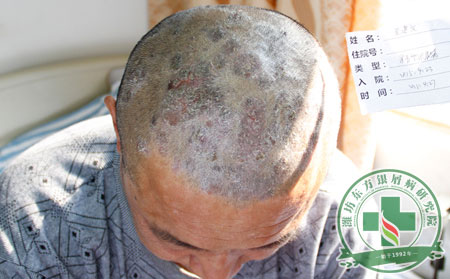 银屑病治疗