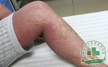 这几种错误让银屑病治疗困难 患者需要规避
