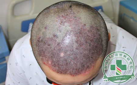 银屑病再次找上门 怎样终结银屑病的复发?
