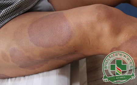 大腿斑块状银屑病怎么治疗能消退