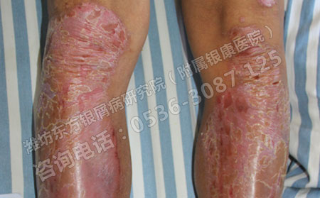 脓疱型银屑病有什么表现