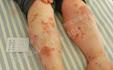 寻常型银屑病的科学诊断方法