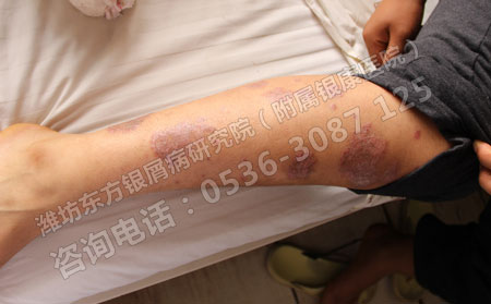 银屑病治疗常识性问题分析