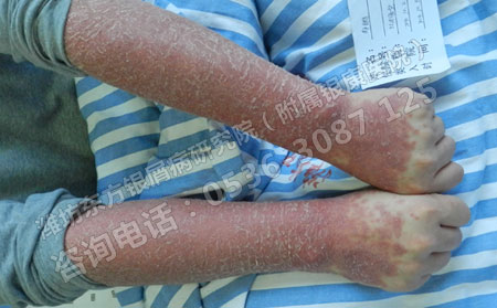 为什么有的银屑病患者中医治疗没有取得好的效果