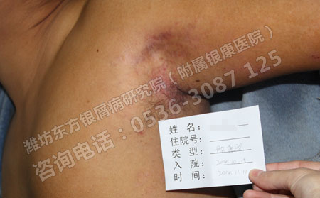 银屑病患者平常要注意什么