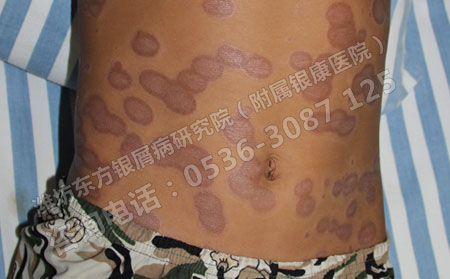 银屑病治疗前应该注意哪些方面