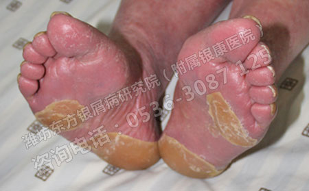 春季银屑病患者手脚干裂怎么办