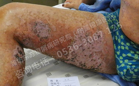 潍坊市皮肤银屑病医院地址