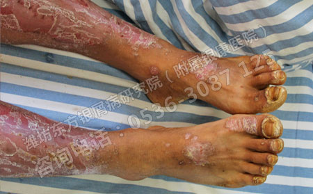 不同病情的银屑病患者要如何进行治疗