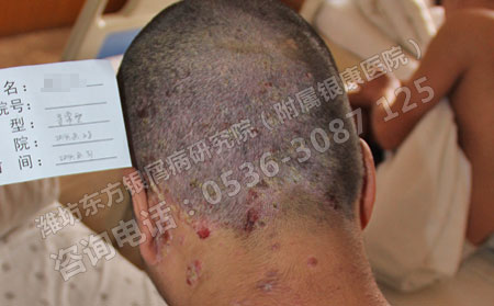 银屑病会导致掉发吗?银屑病患者怎样护发?