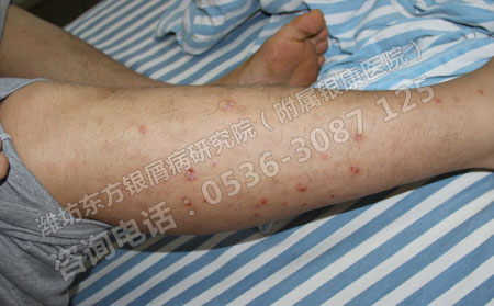 阿维A与常规药物治疗重症银屑病的临床治疗效果